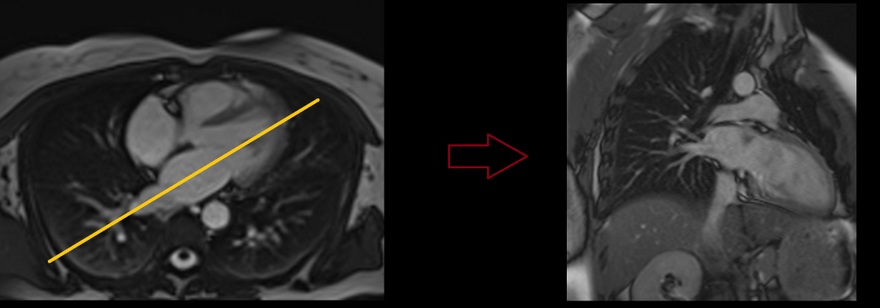 MRI cardiac Right PV planning localiser