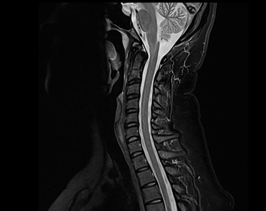 STIR MRI image of the cervical spine