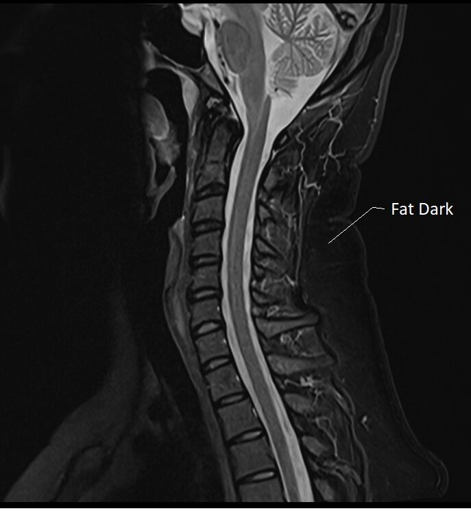 STIR image with aTI of 150 used in spine imaging