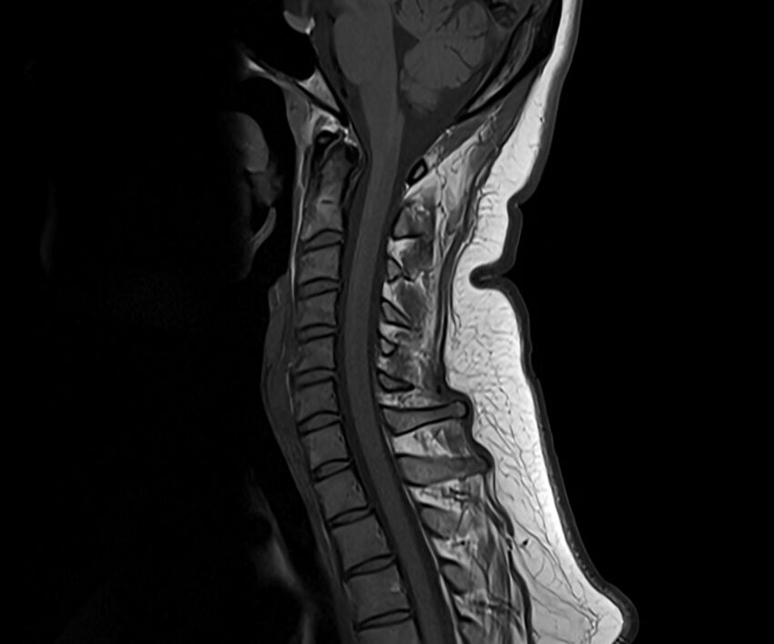 T1 FLAIR MRI image of the cervical spine