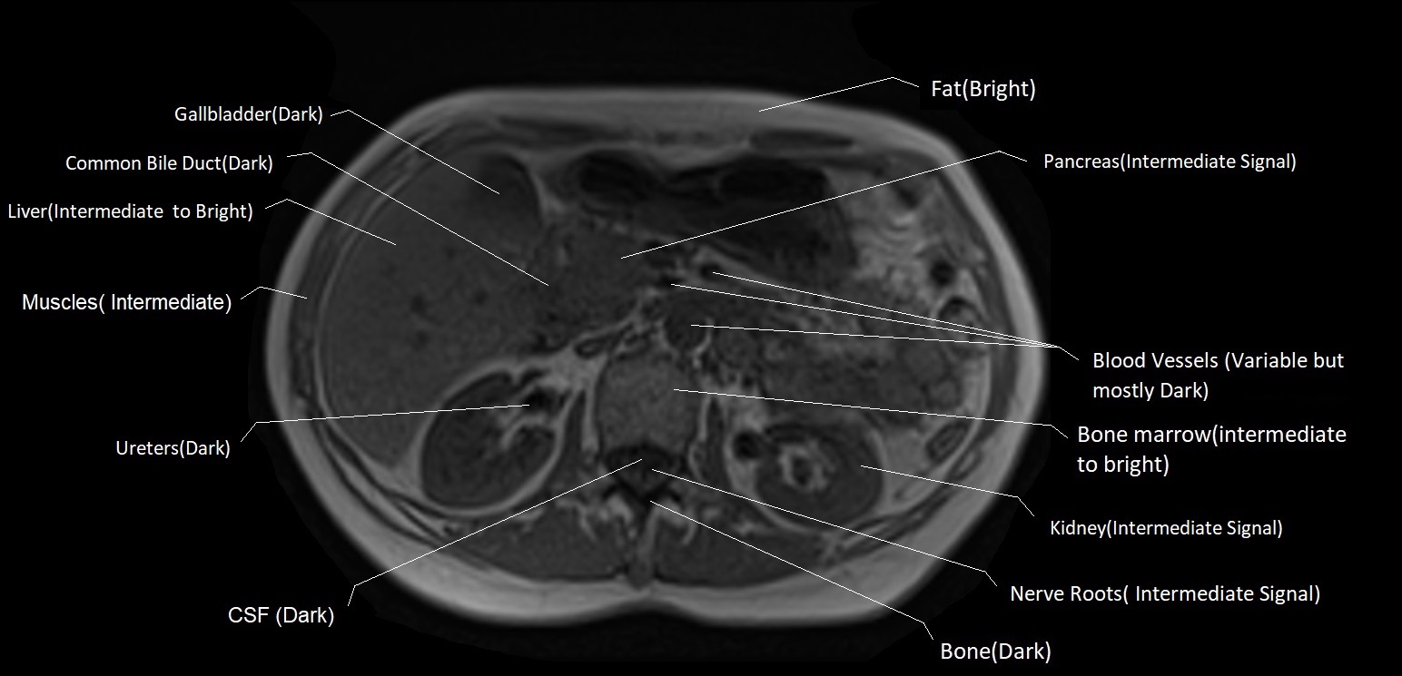 T1 MRI appearance of various tissues and organs in abdomen