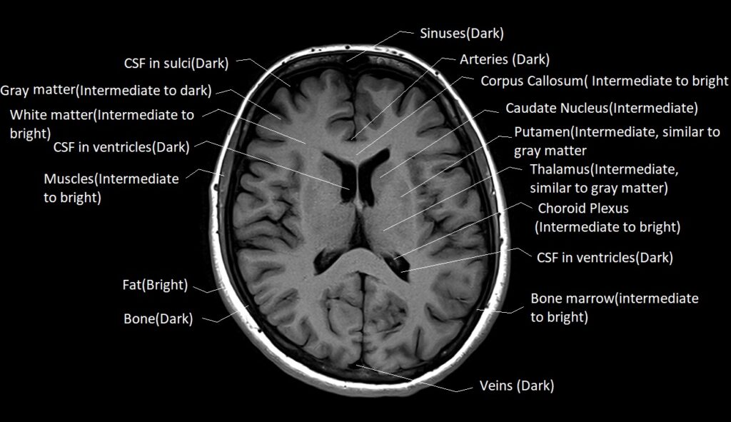 T1 MRI appearance of various tissues in the brain