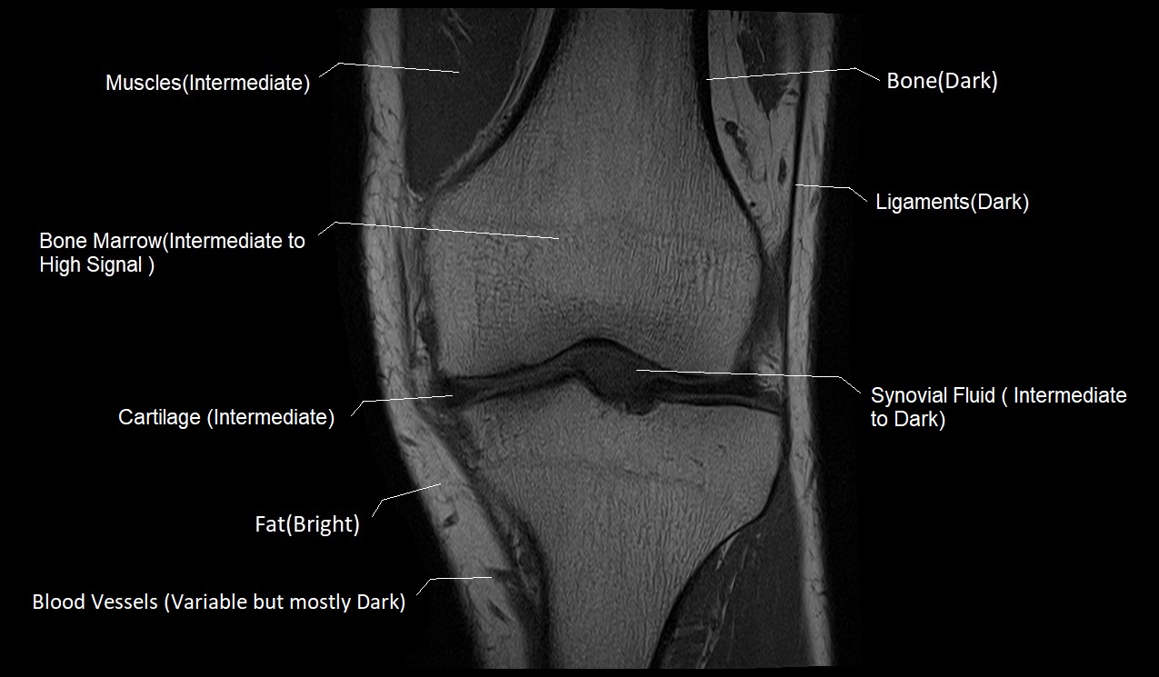 T1 MRI appearance of various tissues in the knee
