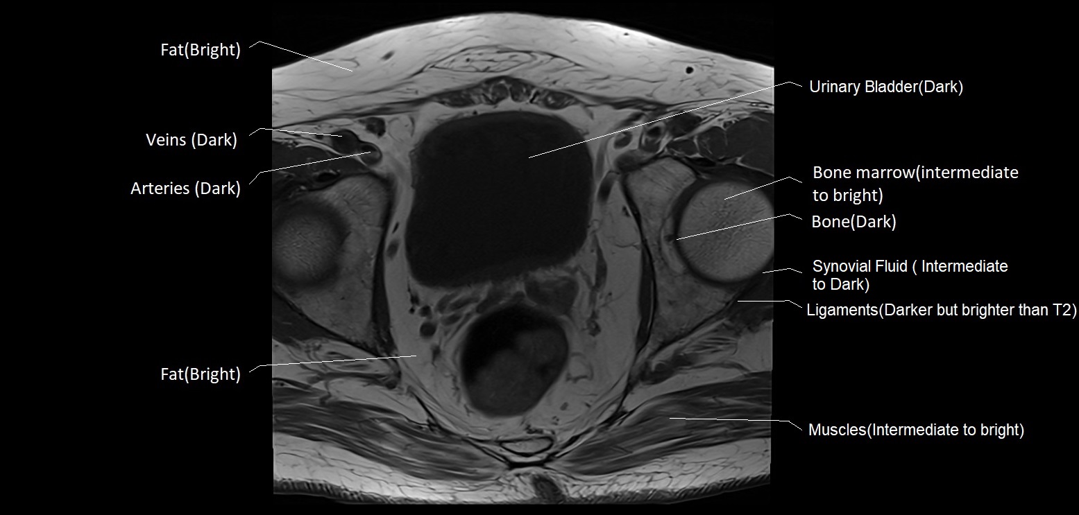 T1 MRI appearance of various tissues in the pelvis