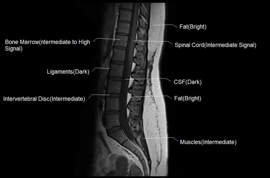 T1 MRI appearance of various tissues in the spine