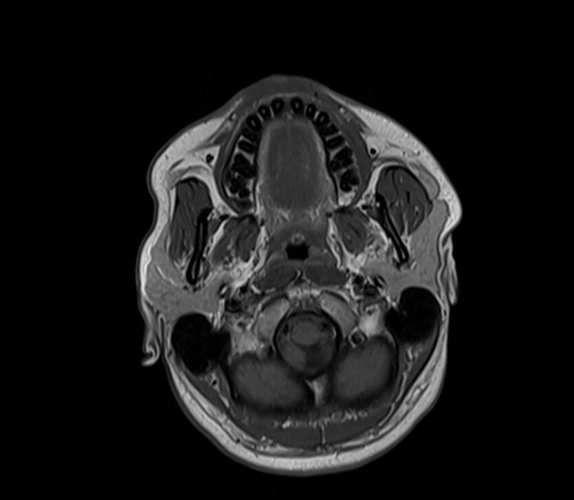 T1 MRI axial image of neck