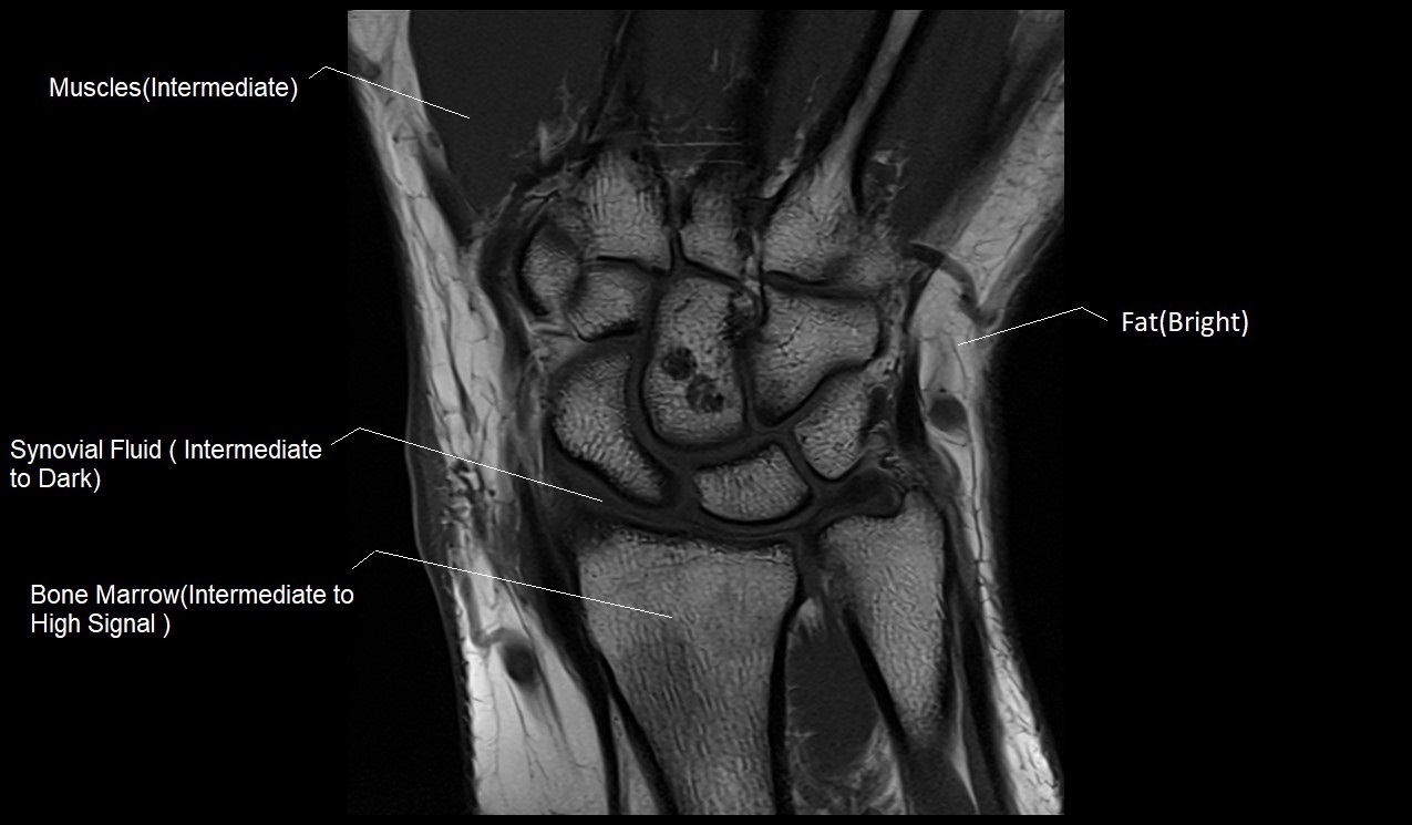 T1 MRI coronal image of wrist