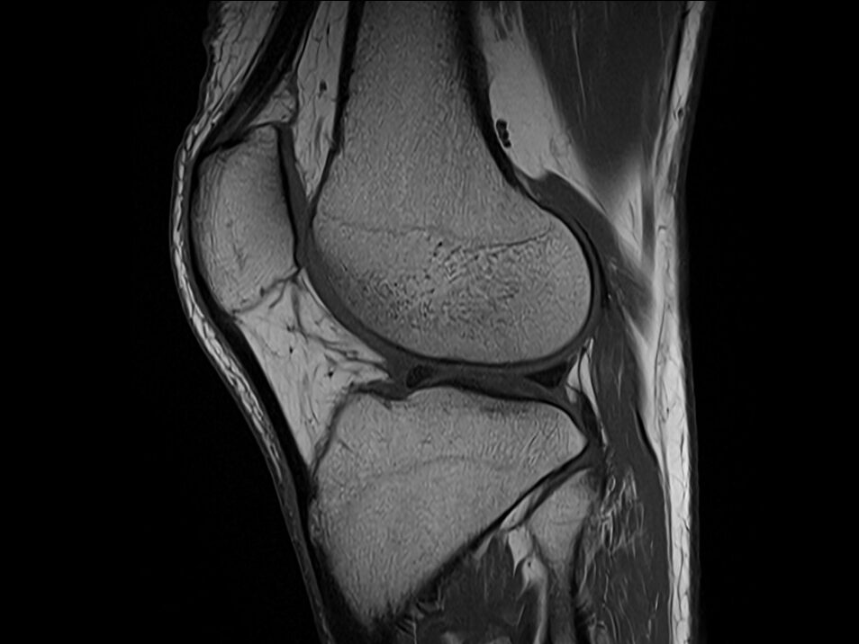 T1 MRI sasirral image of knee in 3T scanner