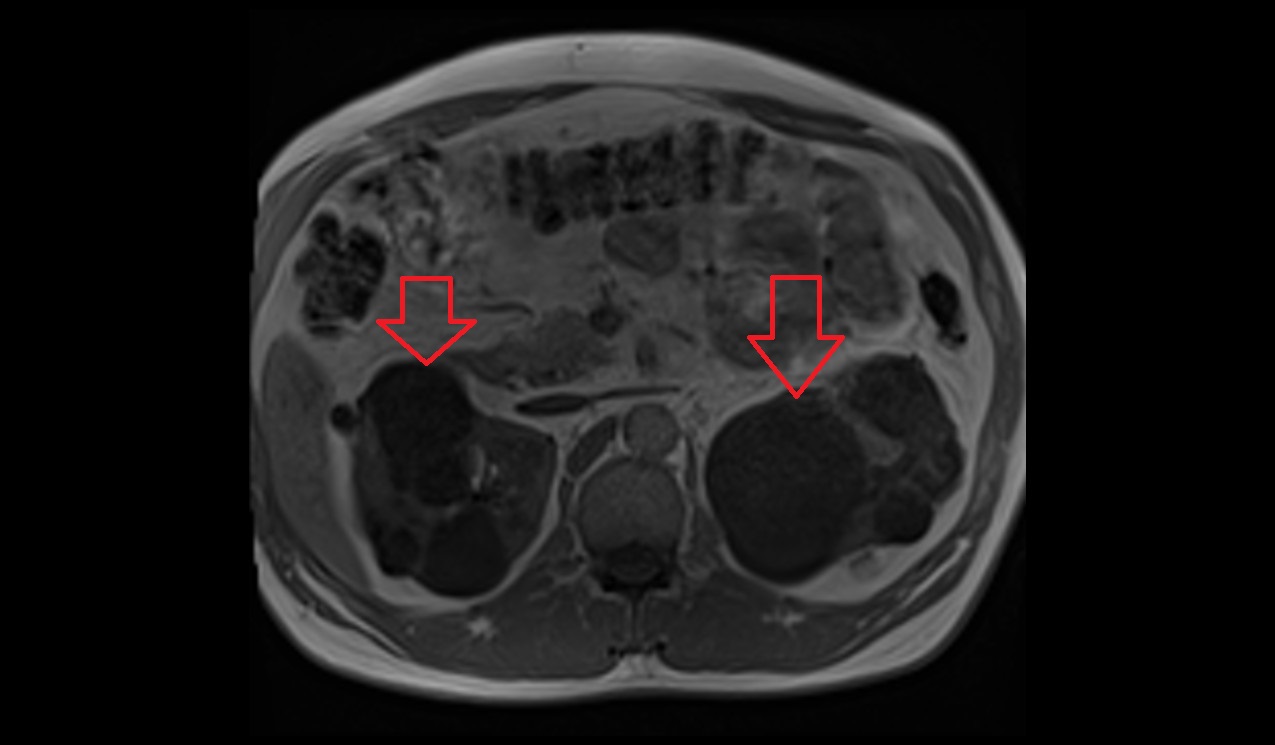 T1 mri appearance of a renal cyst