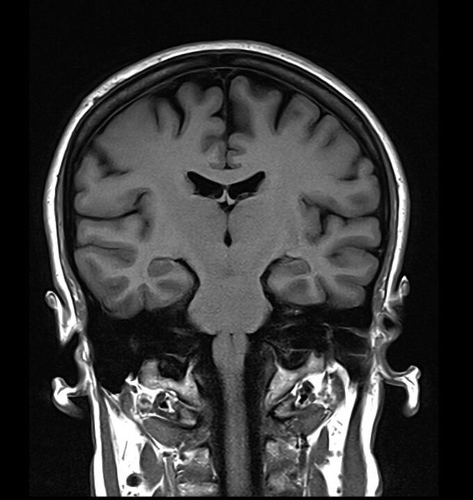 T1coronal brain image in 3T with a ti of 900ms