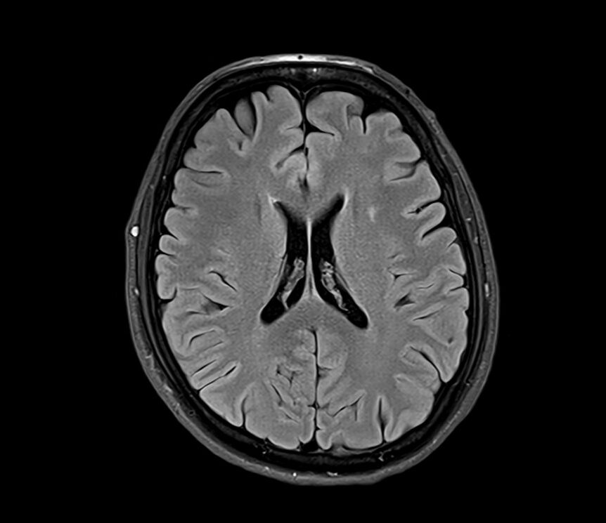 T2 FLAIR image of the brain scan in 3T MRI