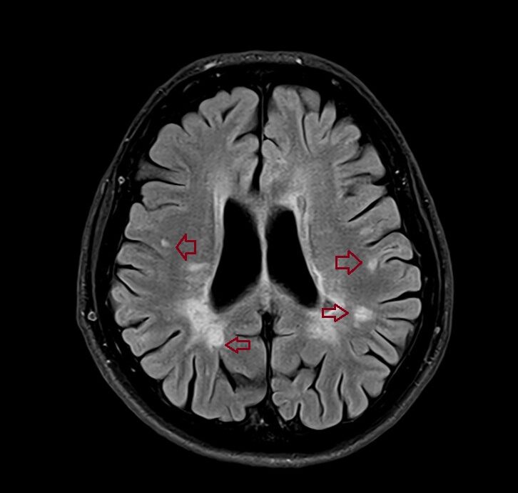 T2 FLAIR image of the brain with multiple sclerosis lesions