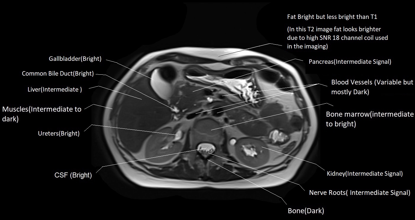 T2 MRI appearance of various tissues and organs in abdomen