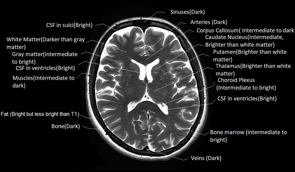 T2 MRI appearance of various tissues in the brain