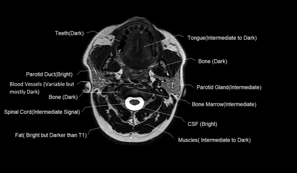 T2 MRI appearance of various tissues in the face