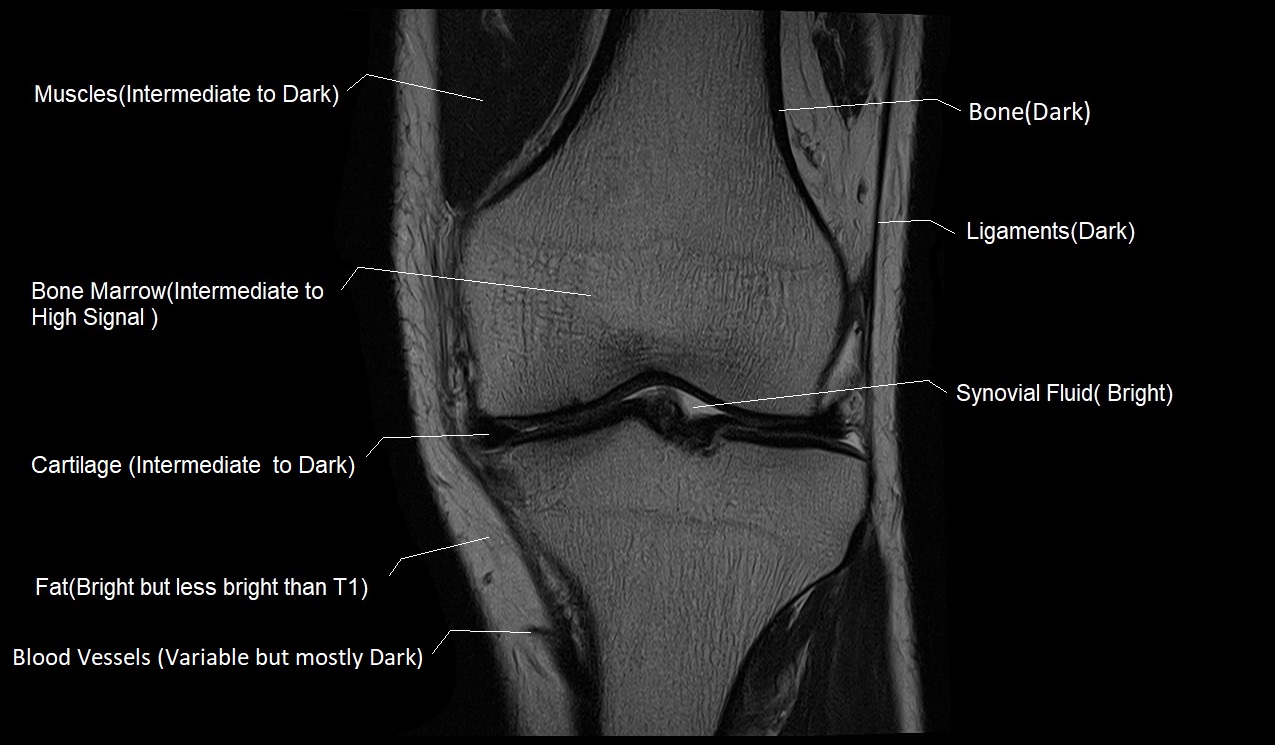 T2 MRI appearance of various tissues in the knee