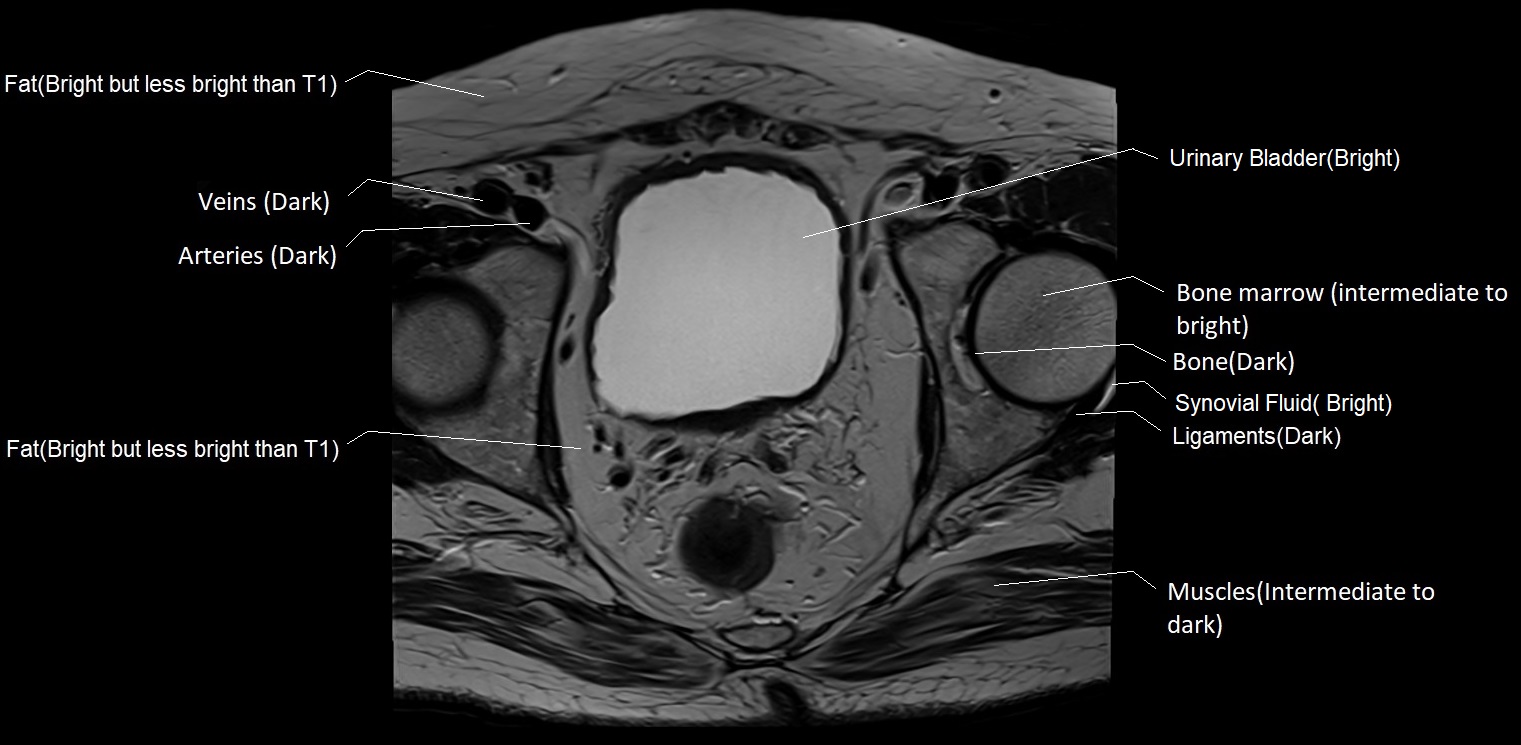 T2 MRI appearance of various tissues in the pelvis