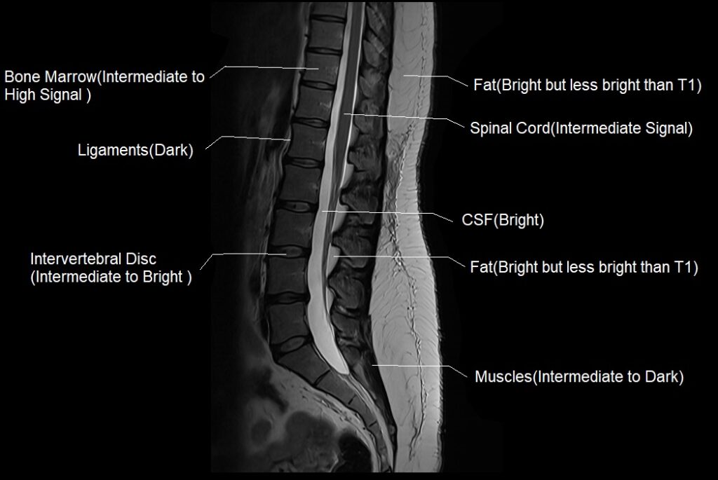 T2 MRI appearance of various tissues in the spine