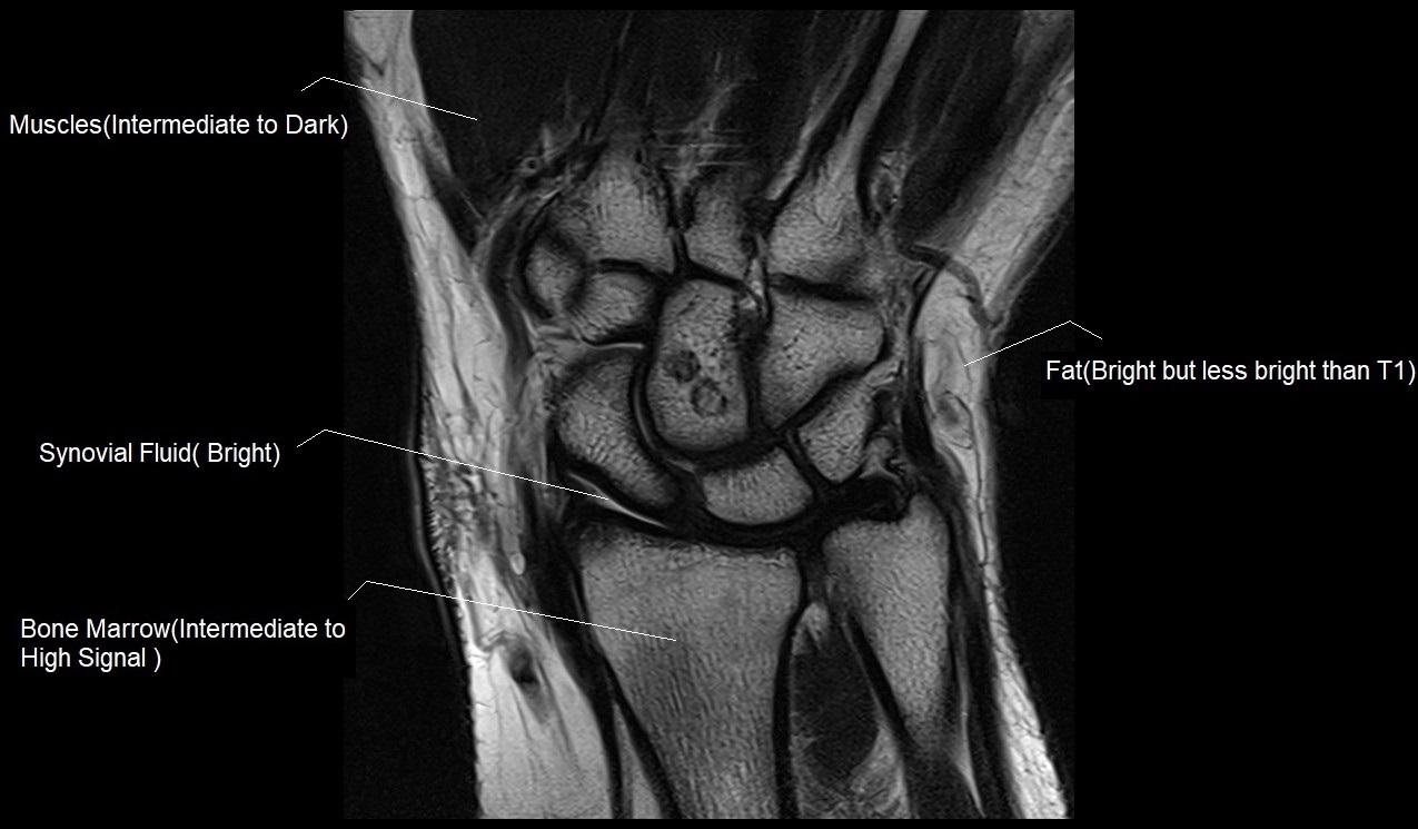 T2 MRI coronal image of wrist