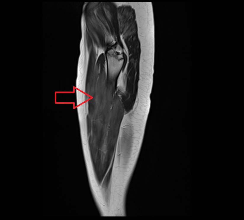 T2 mri appearance of myositis