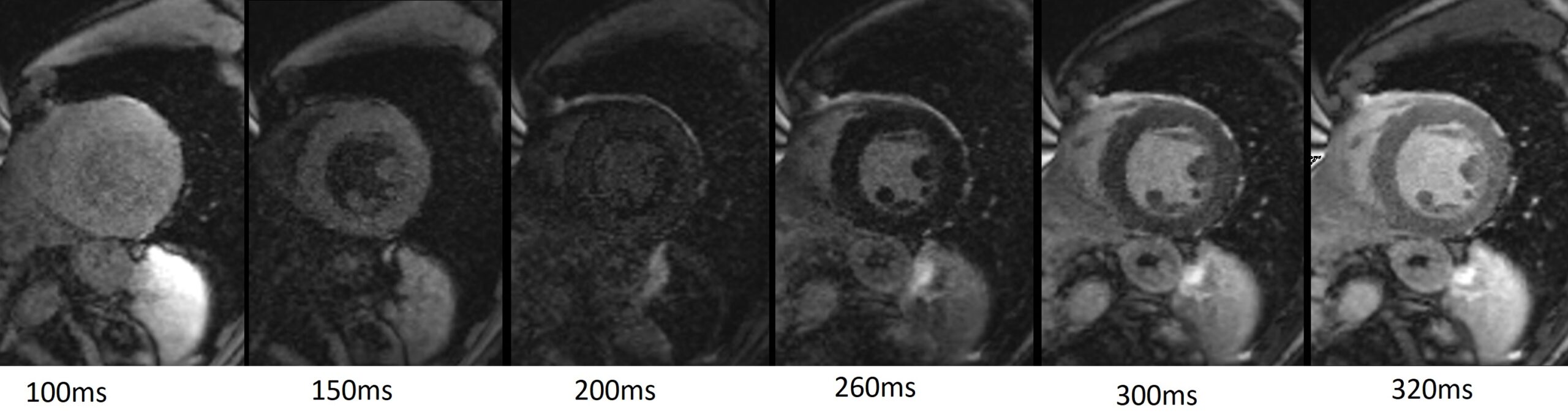 TI Scout (Inversion Recovery scout or Look-Locker sequence) in cardiac MRI