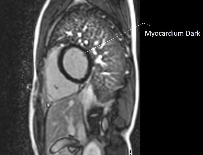 TI of 260ma used in PSIR heart LGE imaging
