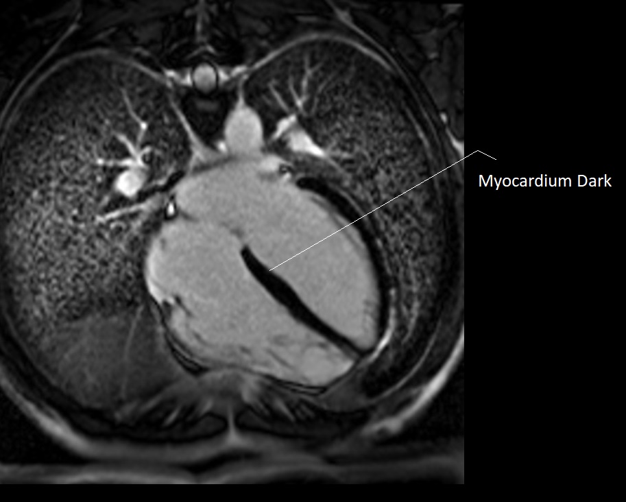 TI of 260ma used in PSIR heart imaging