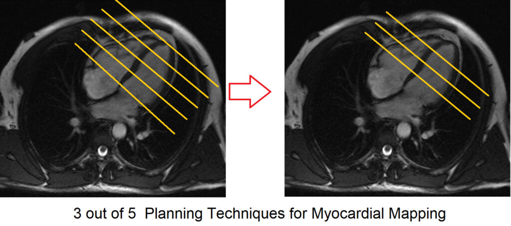 Three out of five planning techniques for myocardial mapping