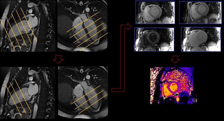 cardiac MRI native T1 mapping planning and protocols