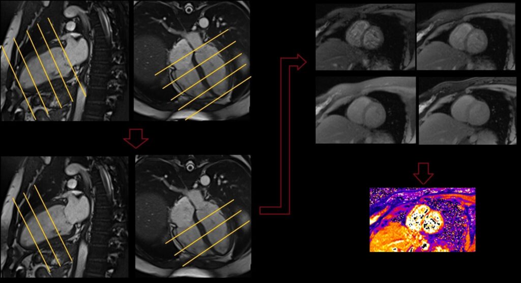 Cardiac mappingT2 star Bright blood planning