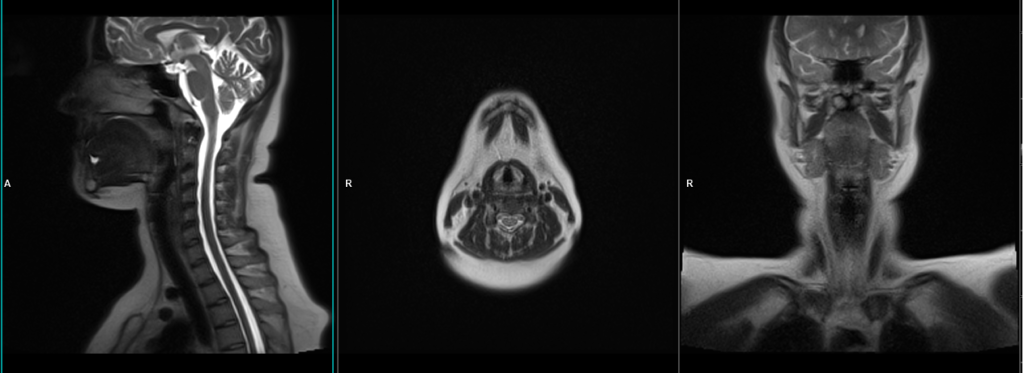 mri larynx protocol and planning localiser