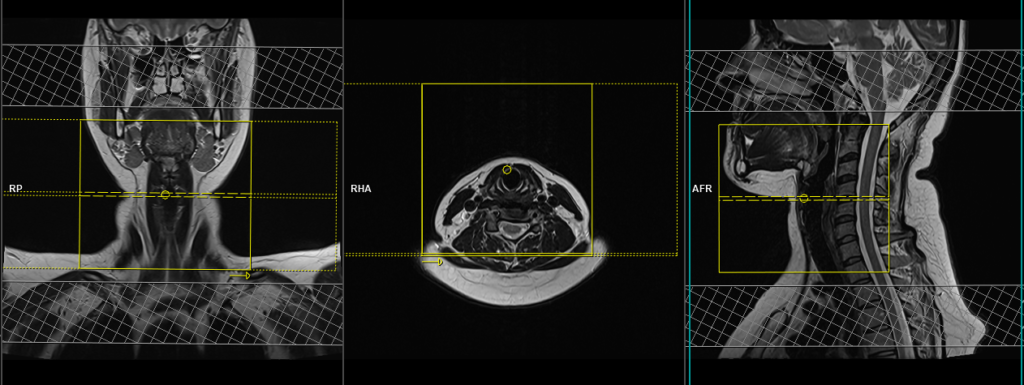 mri larynx protocol and planning of axial scans