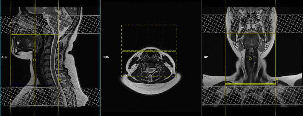 mri larynx protocol and planning of coronal scans