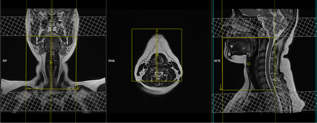 mri larynx protocol and planning of sagittal scans