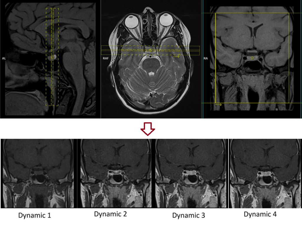 pituitary fossa mri protocol and planning of coronal dynamic scans