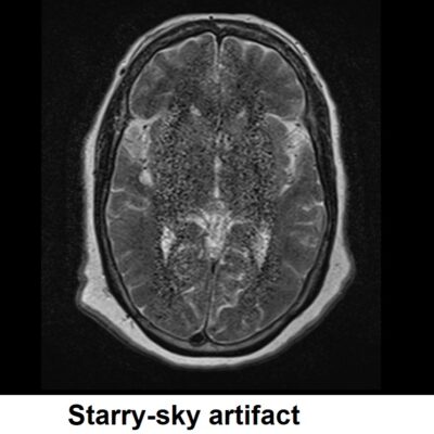 starry-sky artifact MRI starry-sky artifact MRI
