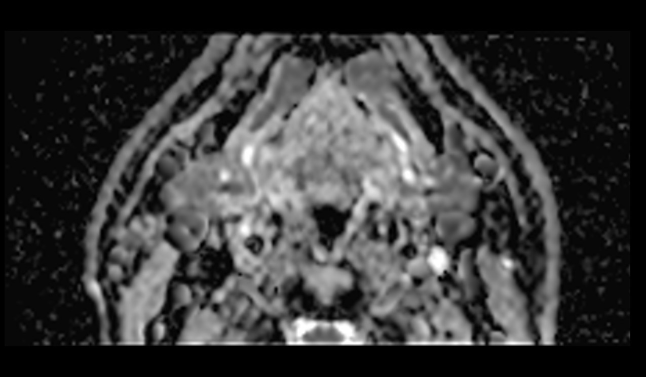 ZOOMit-DWI ADC image of neck