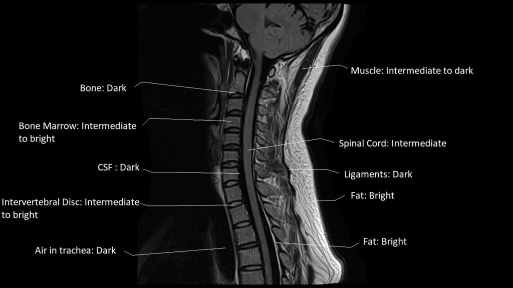 FLAIR MRI image appearance of various tissues in the spine