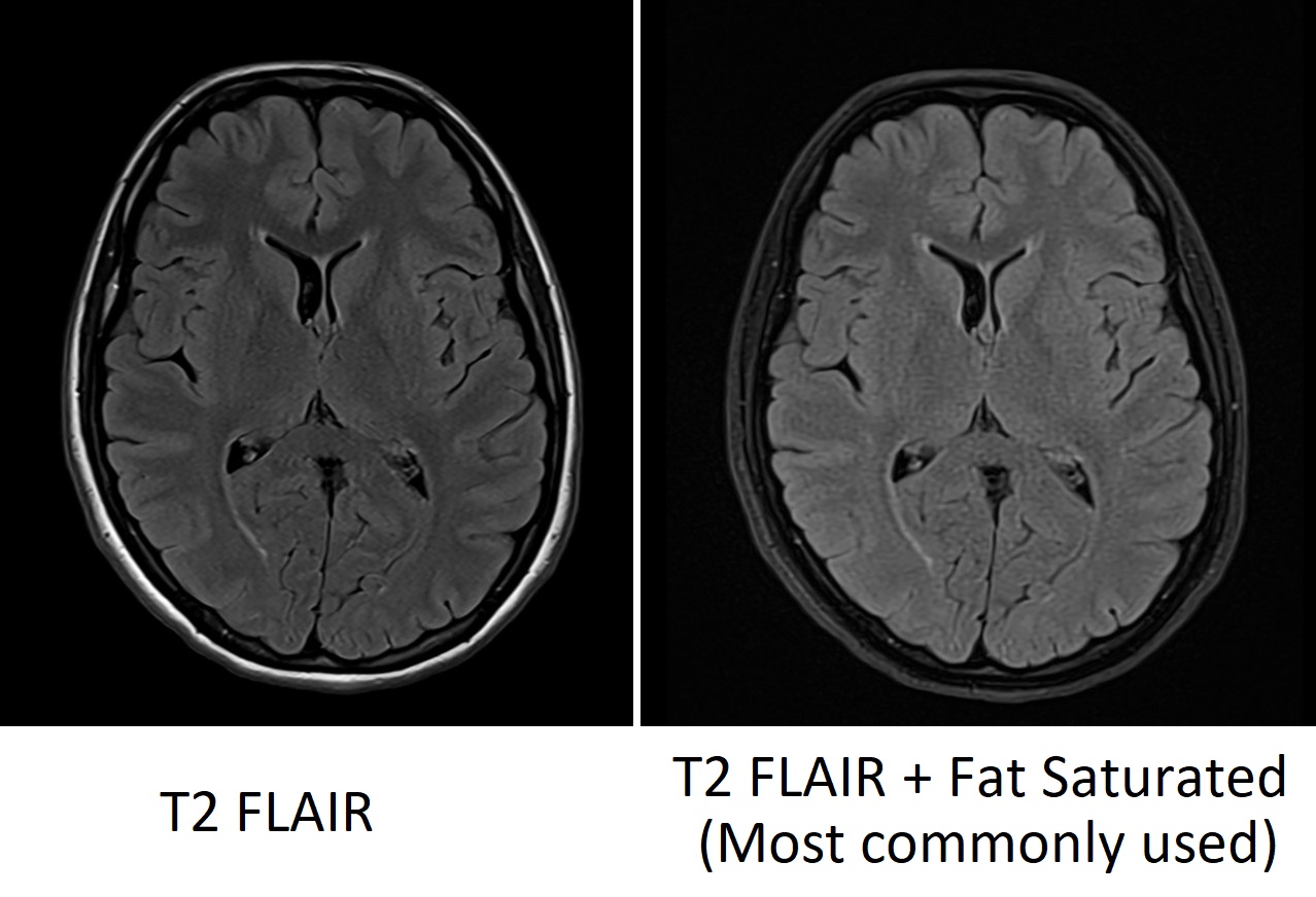 FLAIR MRI image