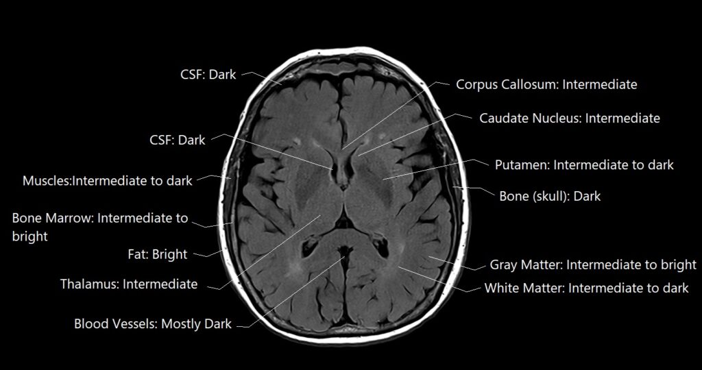 Labelled FLAIR MRI image showing the FLAIR image appearance of various tissues in the brain