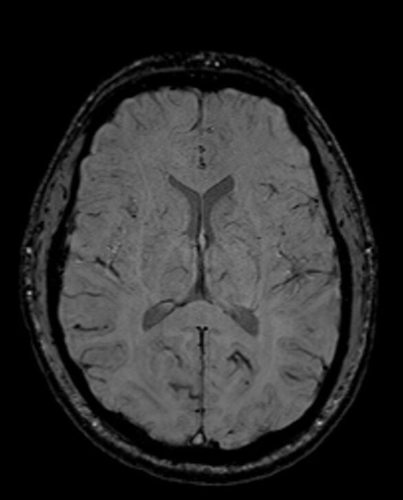 MRI Susceptibility weighted image (SWI image) MRI