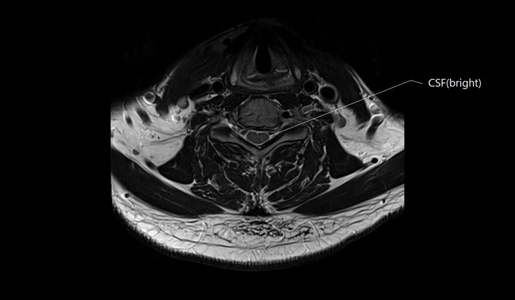 MRI T2 axial image of the cervical spine