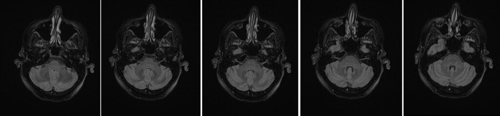 Ménière’s disease axial flair 3D images