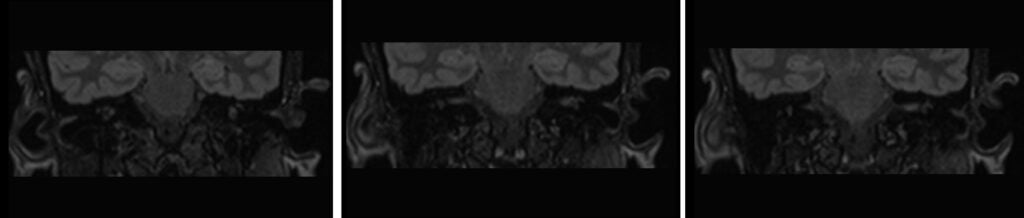 Ménière’s disease coronal flair 3D reconstructed images