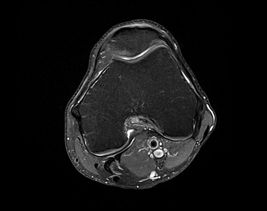 Proton Density(PD) Fat Saturated Axial Image of Knee