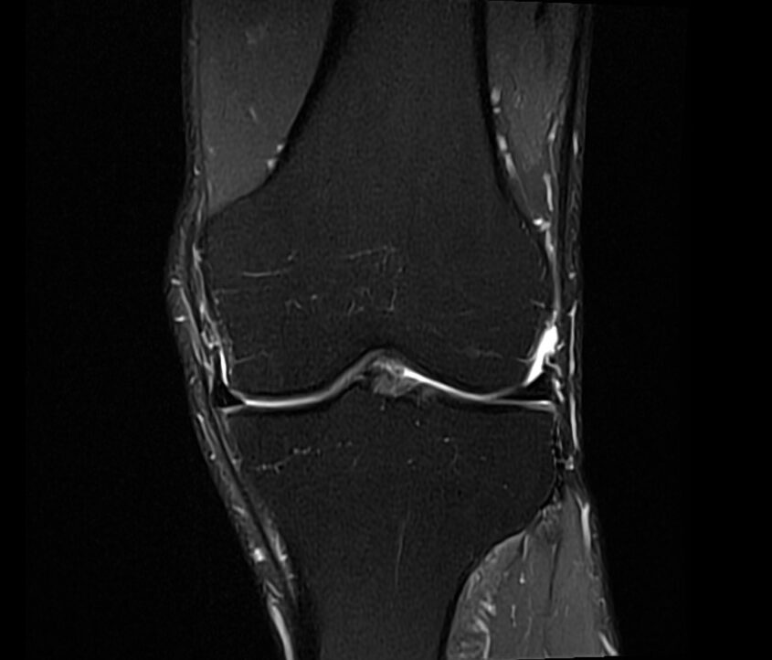 Proton Density(PD) Fat Saturated coronal Image of Knee