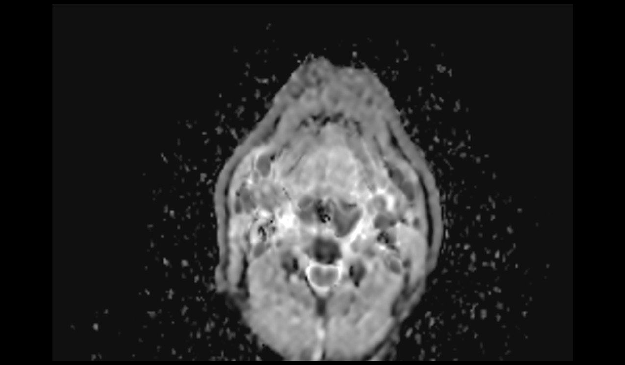 RESOLVE DWI Axial ADC Image of Neck