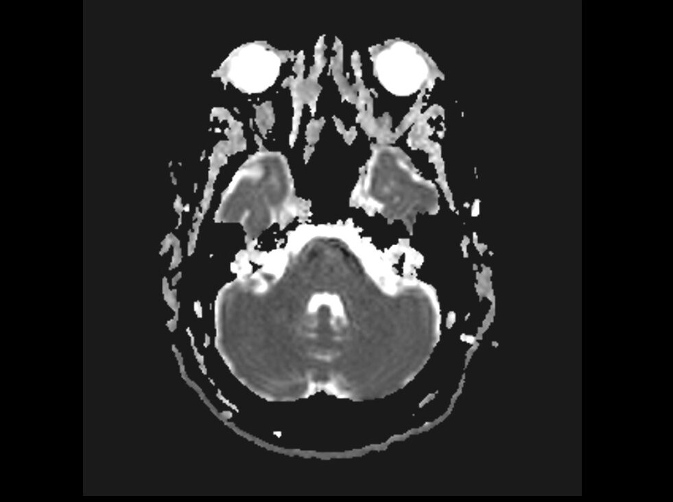 RESOLVE DWI Axial ADC image of brain