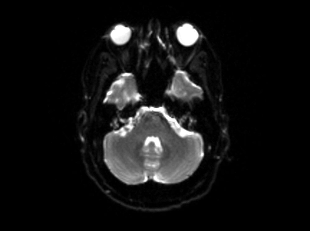 RESOLVE DWI Axial b0 Image of Brain