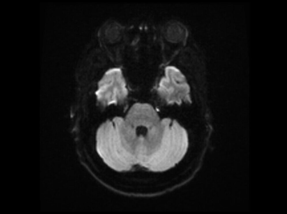 RESOLVE DWI Axial b1000 Image of Brain